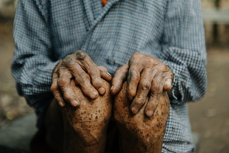 World Leprosy Day 2025 - The Mandatory Training Group UK -