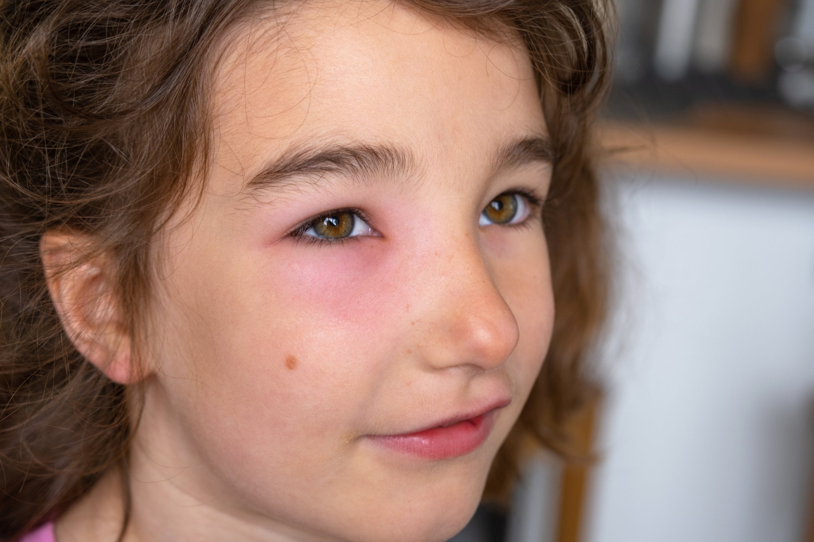 First aid treatment for anaphylaxis in children & babies - ComplyPlus™ - The Mandatory Training Group UK -