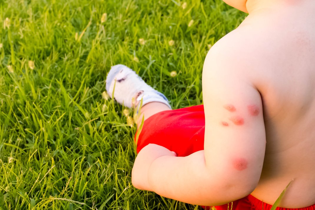 First aid for insect stings in children & babies