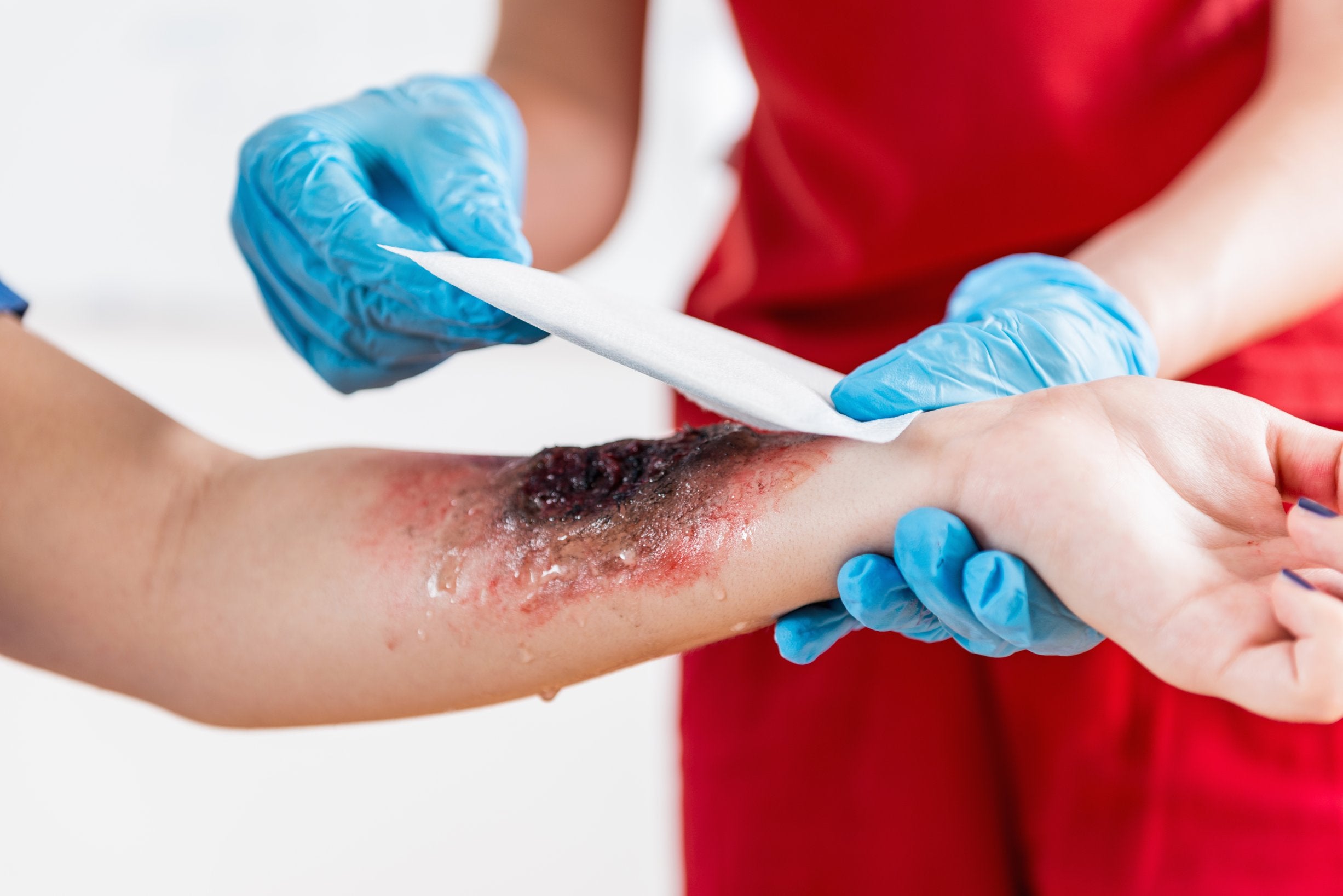 First aid treatment for burns and scalds - ComplyPlus™ - The Mandatory Training Group UK -