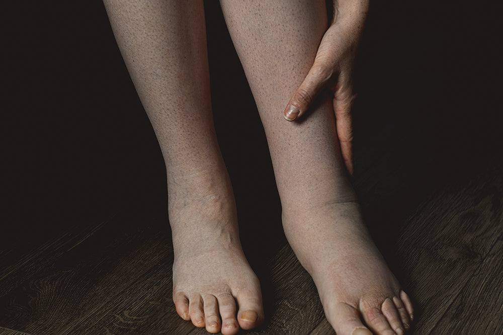 Lymphoedema Awareness Week 2025 - The Mandatory Training Group UK -